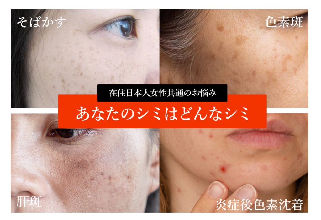 シミタイプを知って色素沈着を撃退 Halley Medical Aesthetics