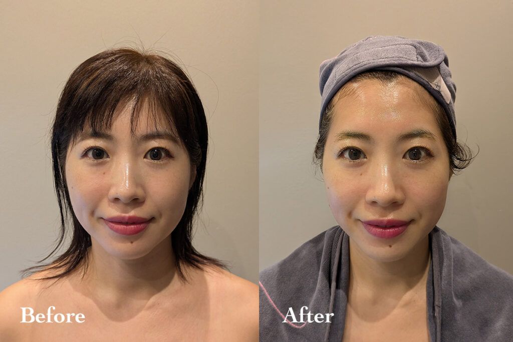施術後、フェイスラインがすっきりした女性のビフォーアフター比較