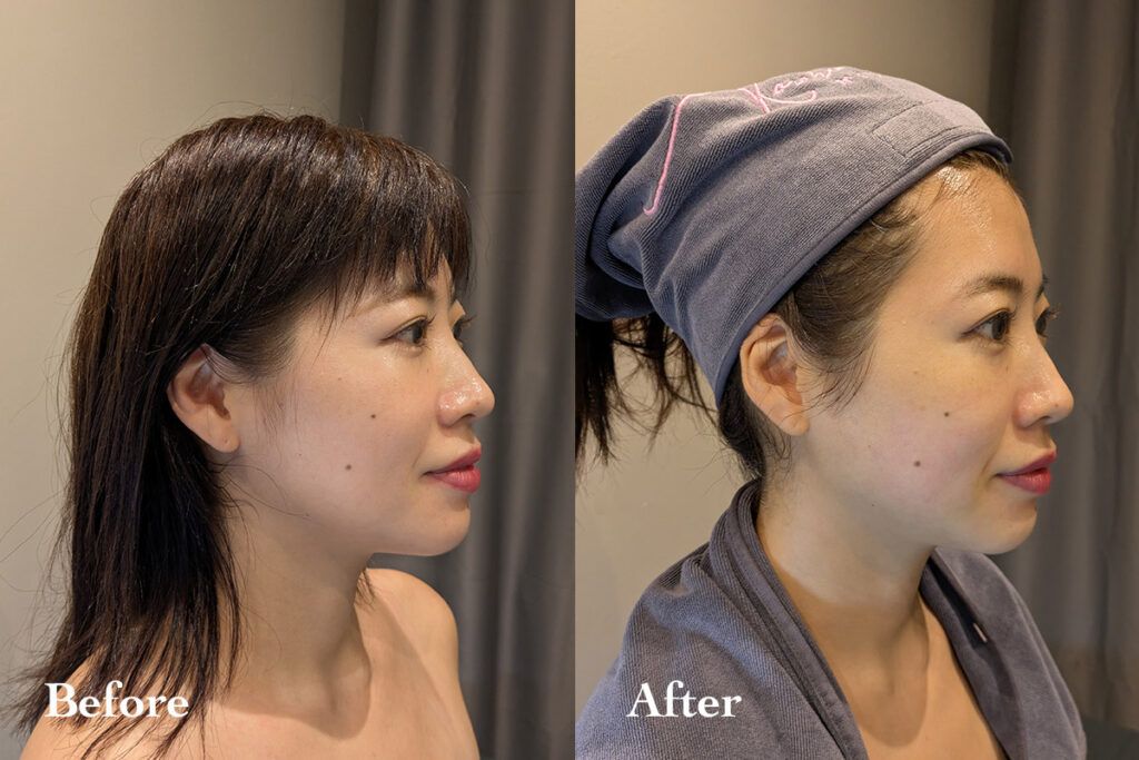 施術後、フェイスラインがすっきりした女性のビフォーアフター比較